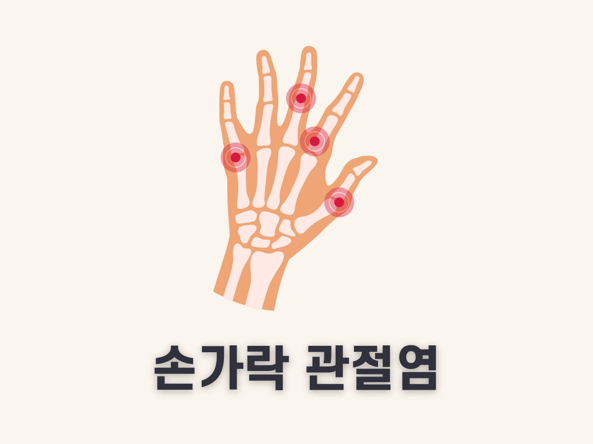 손가락 관절염