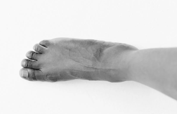 통풍 관련 사진