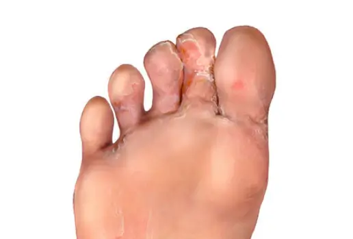 무좀약 바르는 범위