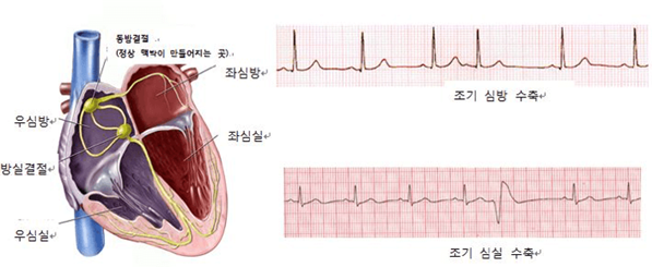 부정맥이란?
