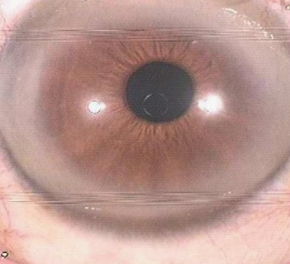 백내장의 증상과 수술 받은 후기와 비용 그리고 관리법과 주의사항