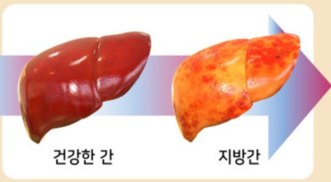 건강한 간과 지방간 이미지