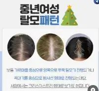 머리카락이 빠지고 정수리가 보이면 여성 탈모 진행별 증상과 해결책