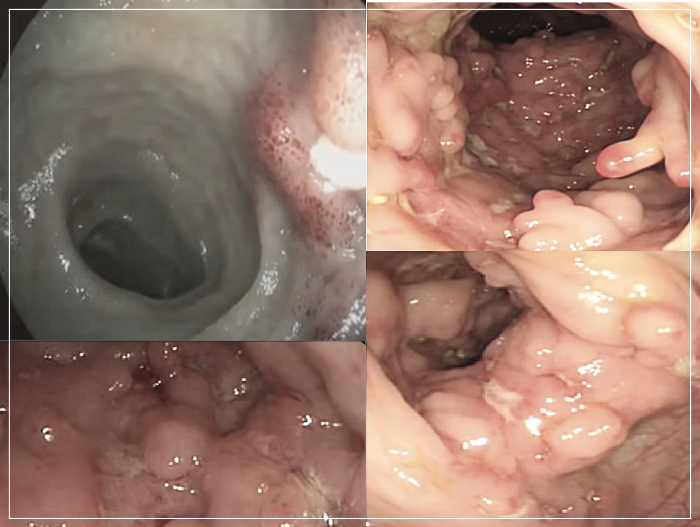크론병-증상사진들