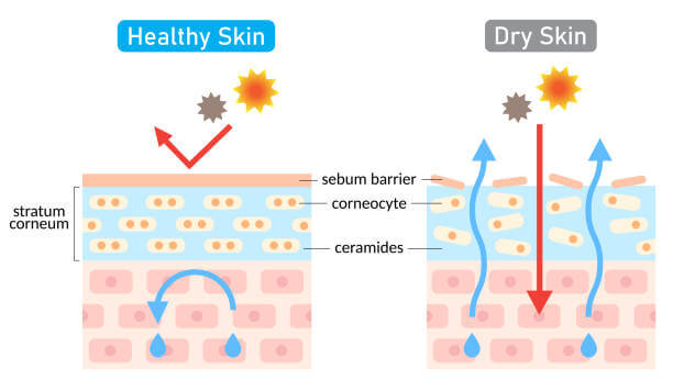 건성 피부 (Dry Skin)