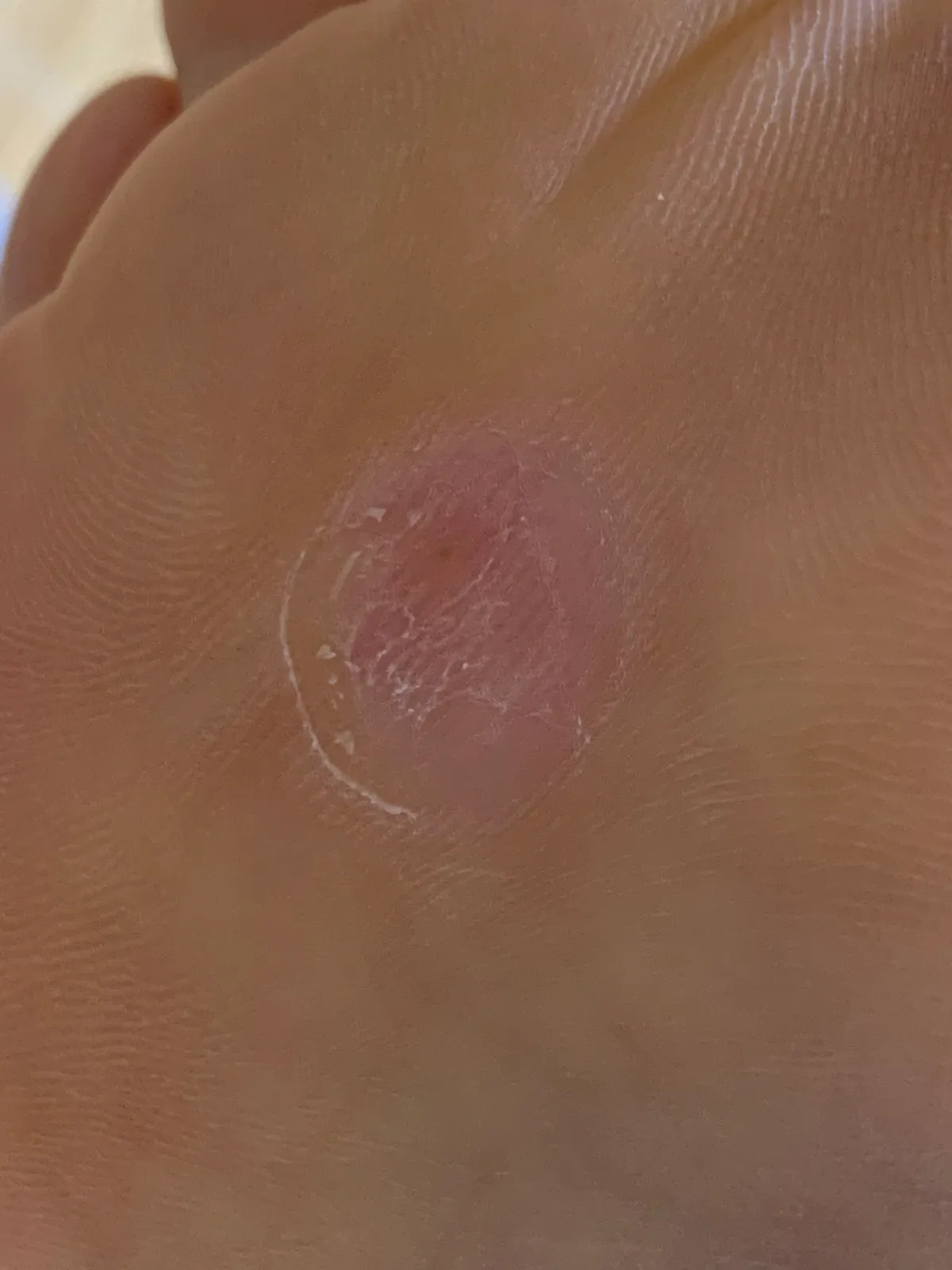 마데카밴드-사용후-발상태