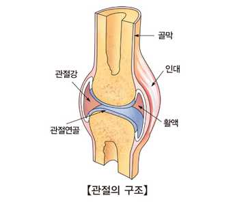 관절염 초기증상