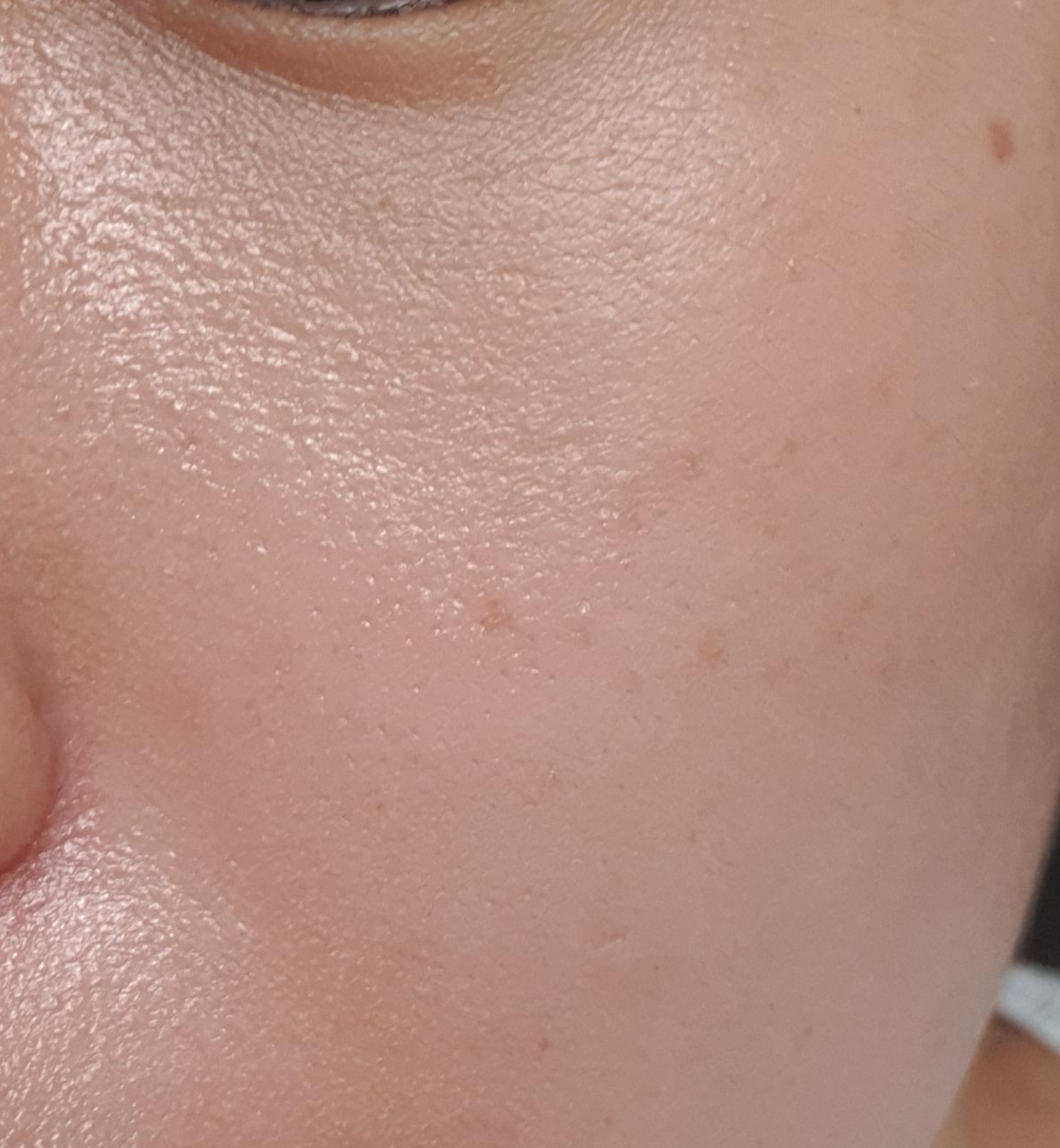 팩트 사용 후 6시간 뒤(오른쪽 뺨)