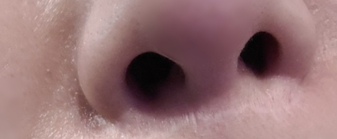 인중 축소 수술 후기