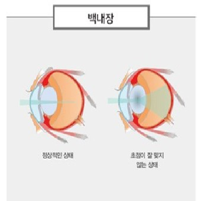 백내장