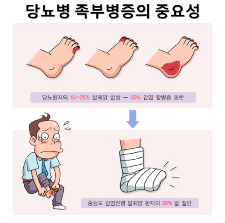 당뇨, 신경손상으로 인한 괴사