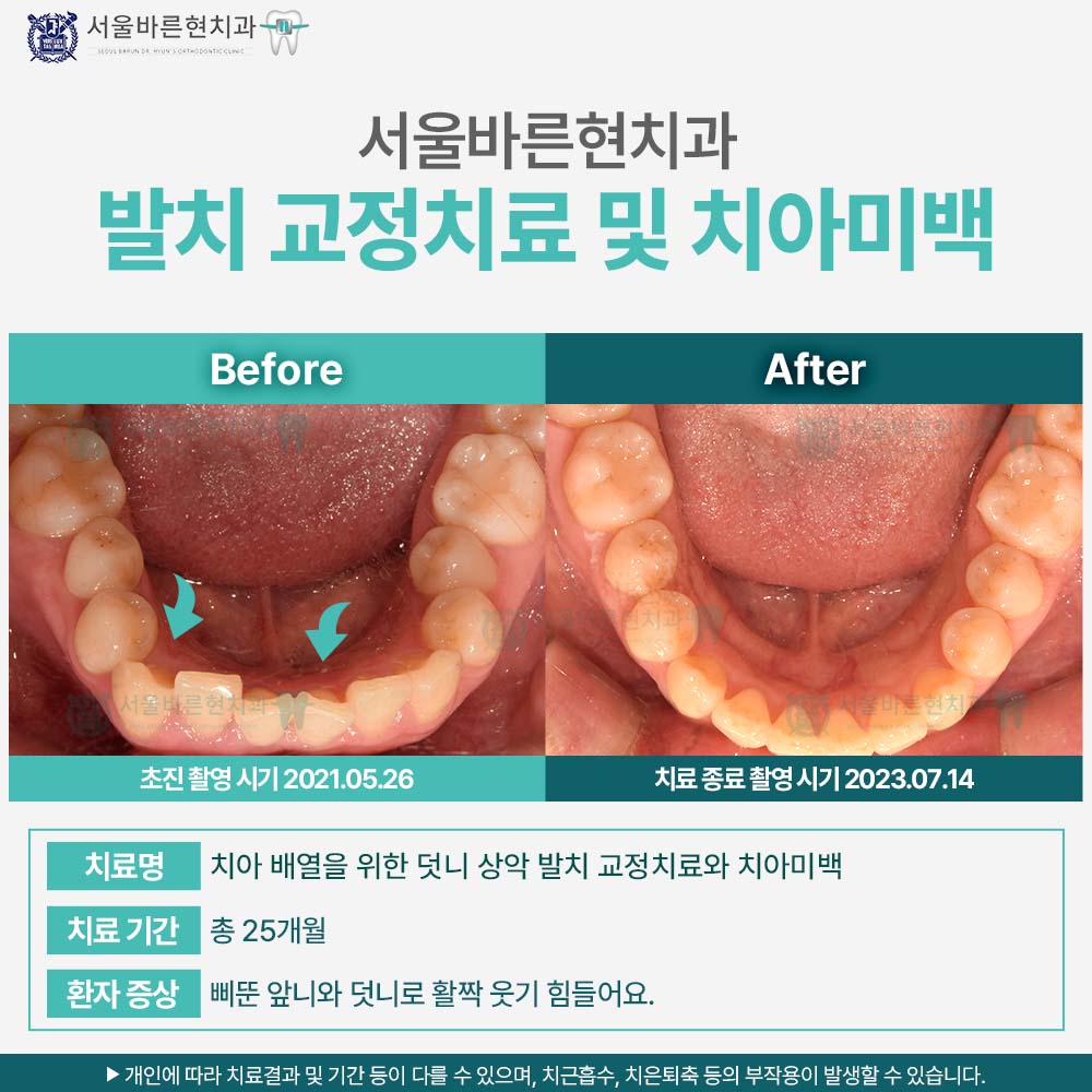부산치아교정