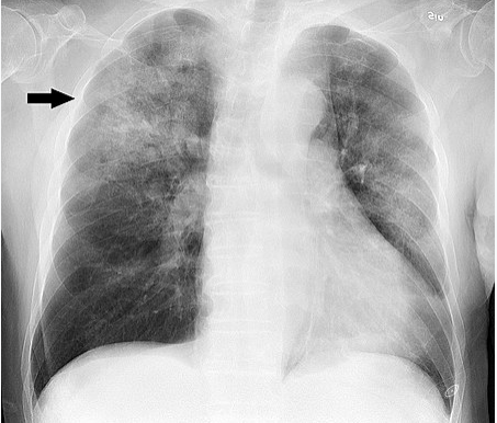 폐렴 증상 x-ray사진(출처: 위키백과)