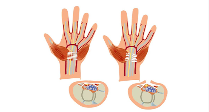 손목터널증후군