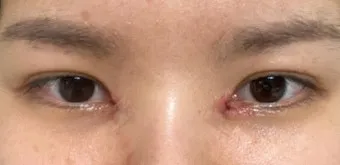 눈물샘 뚫는 수술 간단한가요에 대한 수술정보_10