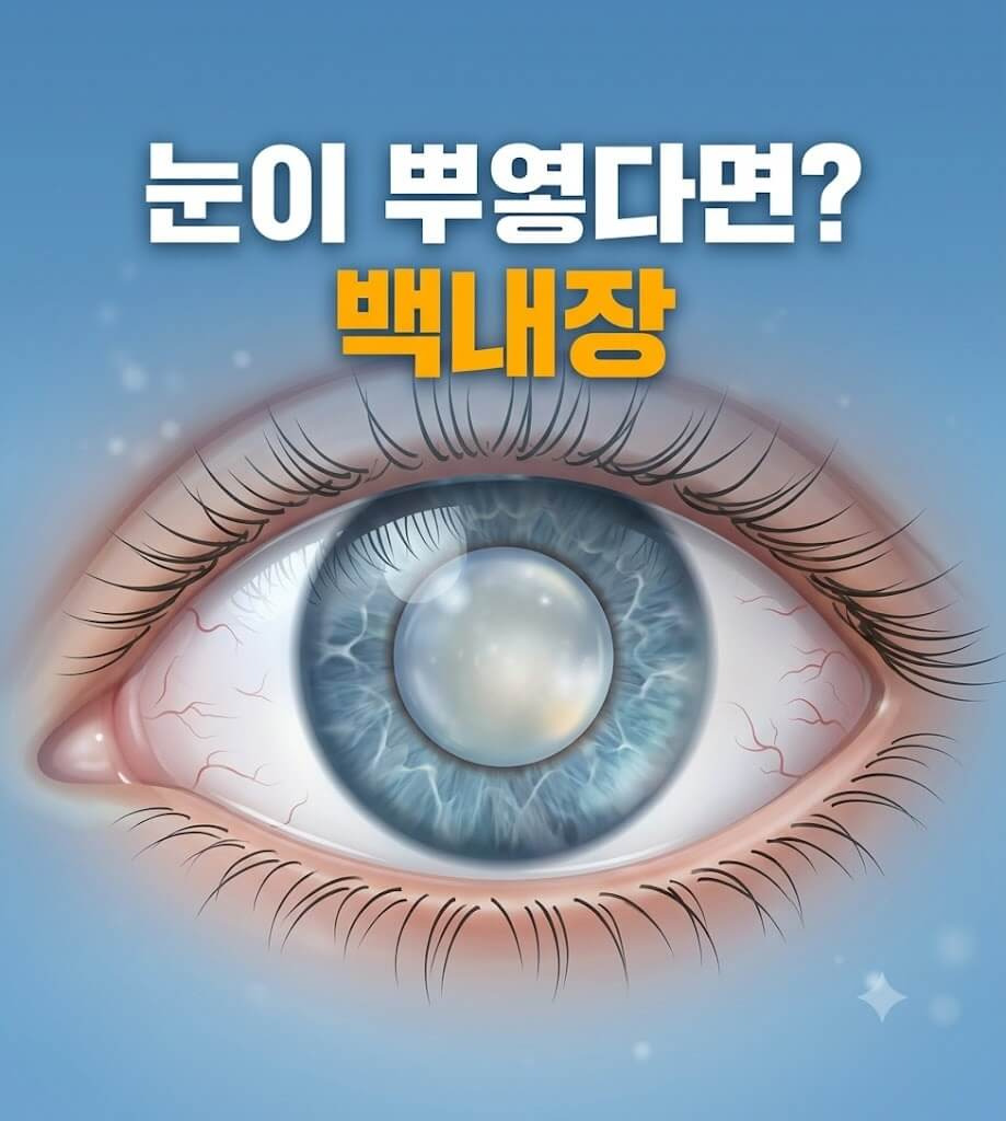 뿌옇게 변한 눈동자를 표여주는 인포그래픽