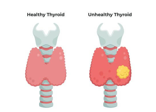 갑상선 목소리 변화