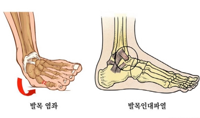 발목_부상_종류