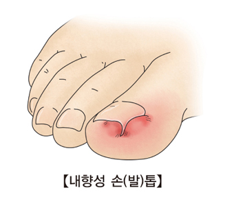 내향성 손밭톱 출처 서울 아산병원 홈페이지