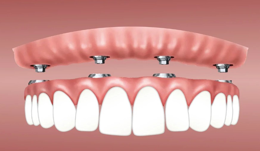 평택시-임플란트-치과-가격-비용-싼-곳,저렴한-곳,잘하는-곳,유명한-곳-BEST20-추천20