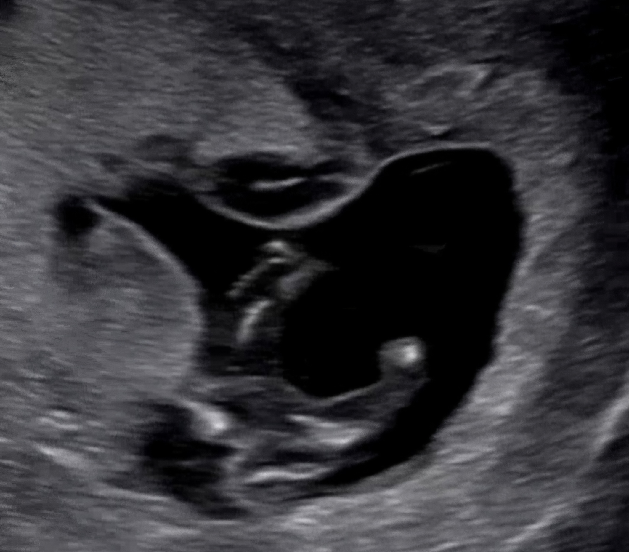 태아 성별확인 각도법 관련사진