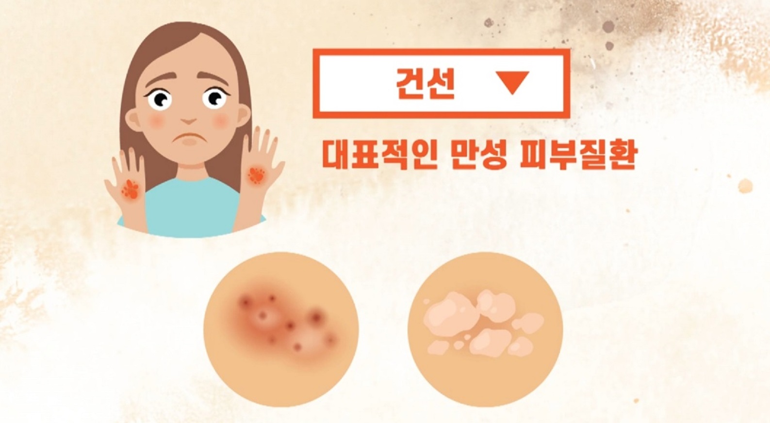 EBS명의-피부-명의-최용범-교수-대상포진-건선