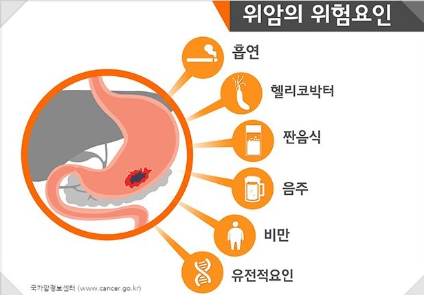초기증상이 비슷한 위암, 위염, 역류성식도염 예방을 위해 위내시경은 필수