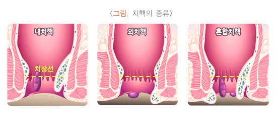치핵의 종류