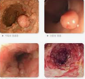 젊은층까지 확산되는 대장암