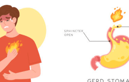 역류성 식도염 증상 10가지, 자연치료 방법