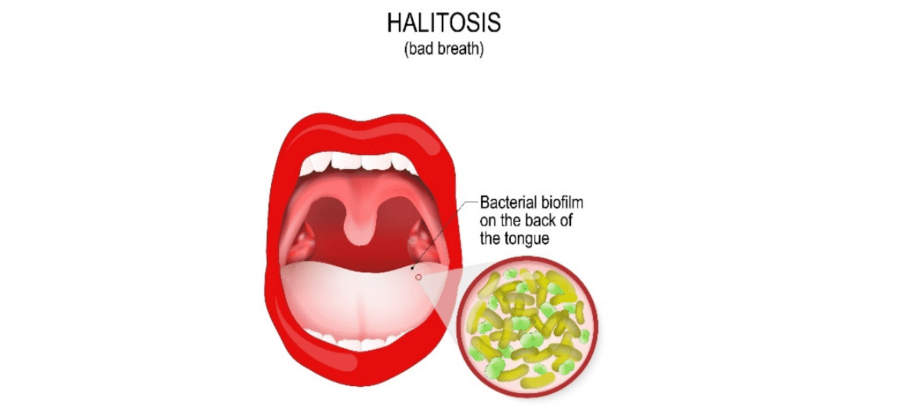 입냄새 주요원인