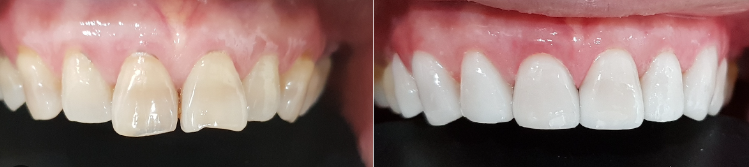 라미네이트 무엇 장점 단점