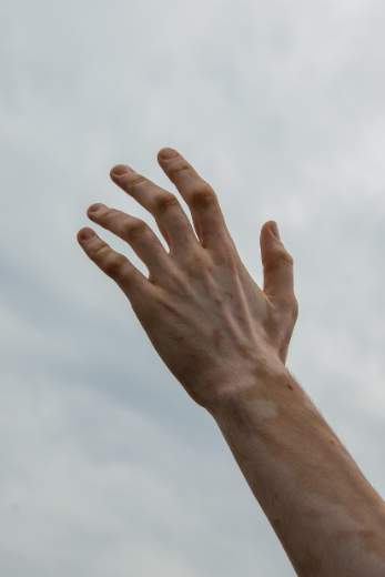 구성환이 앓고 있는 ‘백반증’, 단순한 피부 변화가 아닌 질병