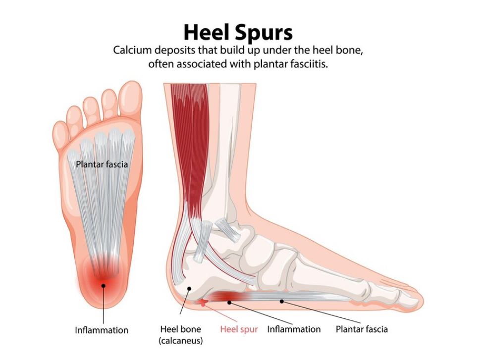 족저근막이 손상되면 족저근막염이 발생하게 된다.