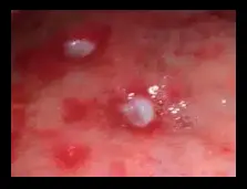 수족구 빨간 띠. 혀 호발