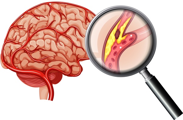 뇌졸중-전조증상