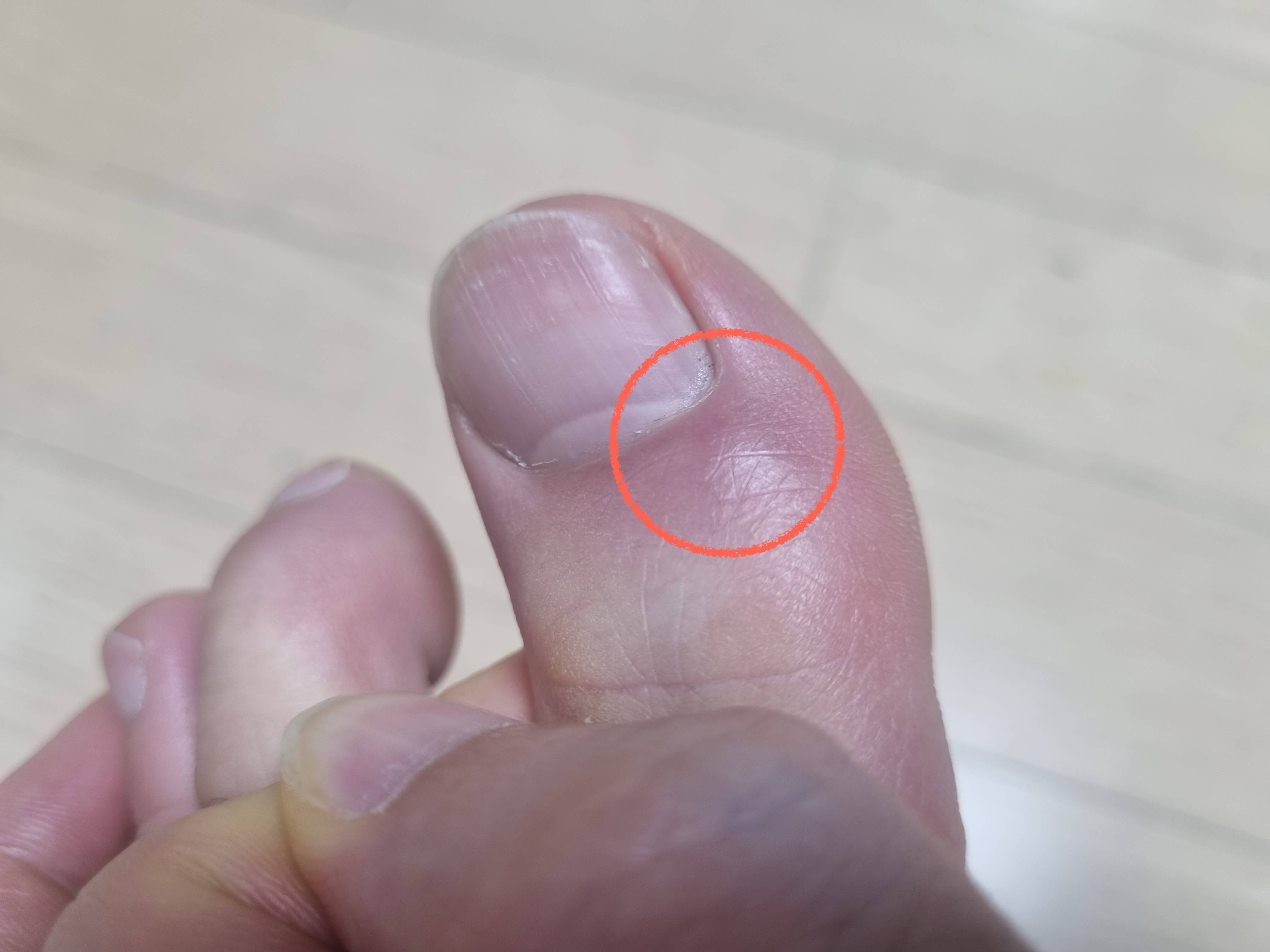 엄지 발가락 통증