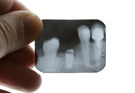 수면 임플란트 가격