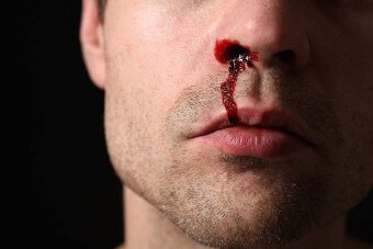 턱에-수염이-많은-남자가-오른쪽-코에서-코피를-빨갛게-흘리는-모습