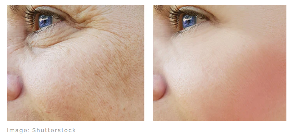 피부재생 전과 후 상태