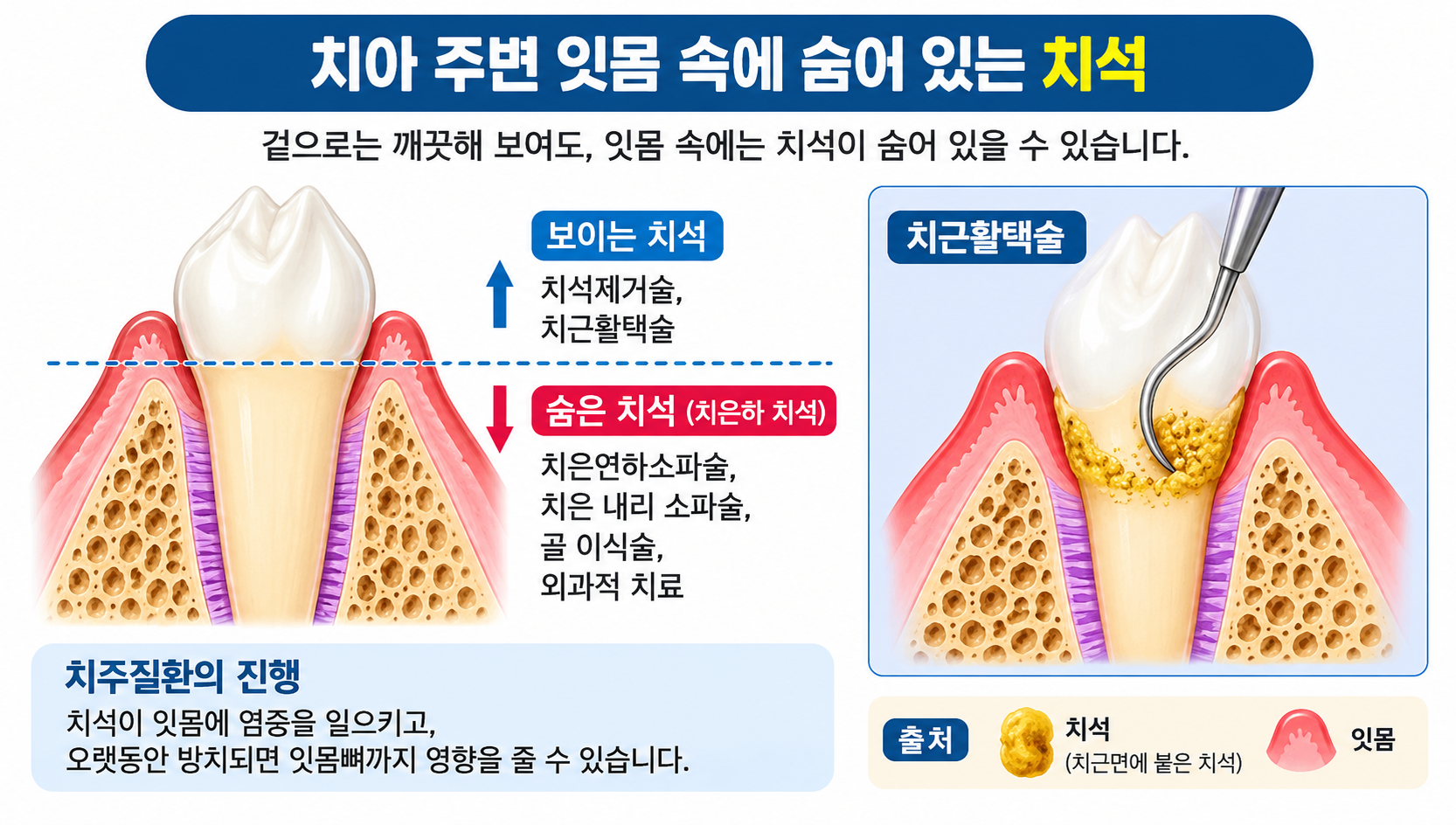 잇몸 안쪽 치근의 치석을 제거하는 치은활텍술 이미지