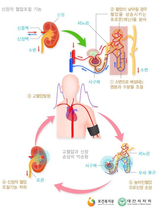 고혈압과 신장, 뇌 염증의 관계 발견 관련 이미지