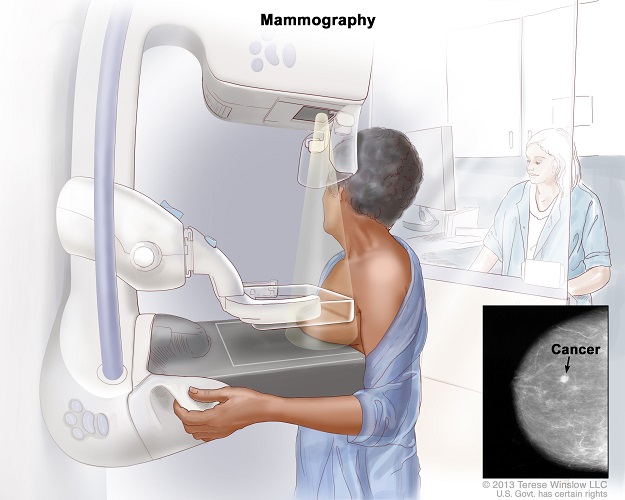 여성이 맘모그래피 검사를 받는 모습과 유방암 발견 X-ray 영상을 함께 보여주는 의료 일러스트