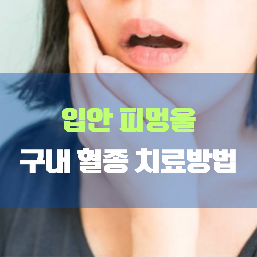 입안 피멍울 구내혈종 경험담, 증상 및 치료법 자세히 알아보았습니다.
