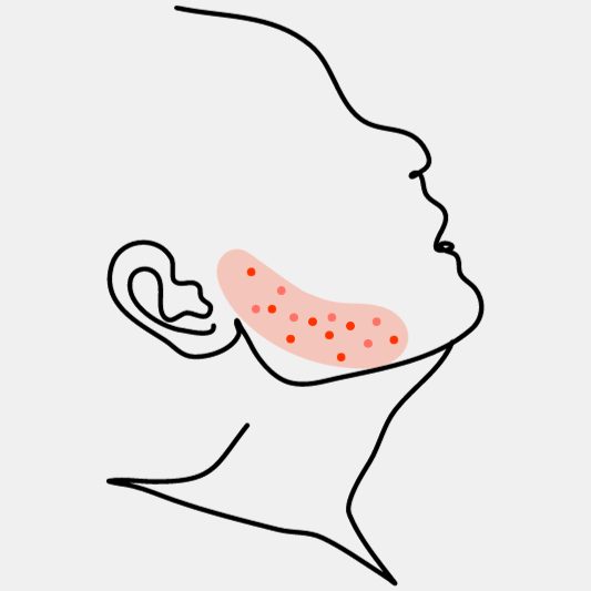 모낭염-이미지-예시
