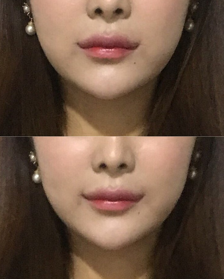 입술확대수술