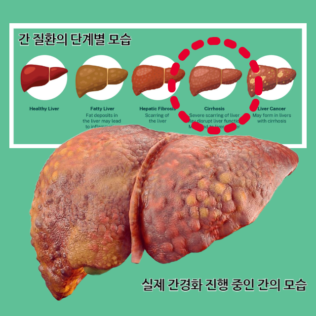 간경화-초기-증상