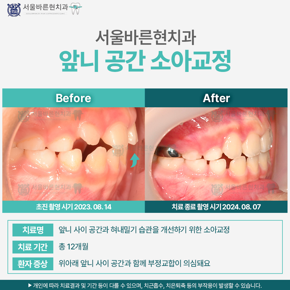부산마린시티소아교정