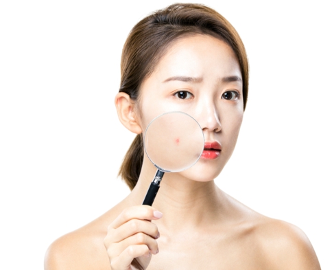 부위별 여드름 원인