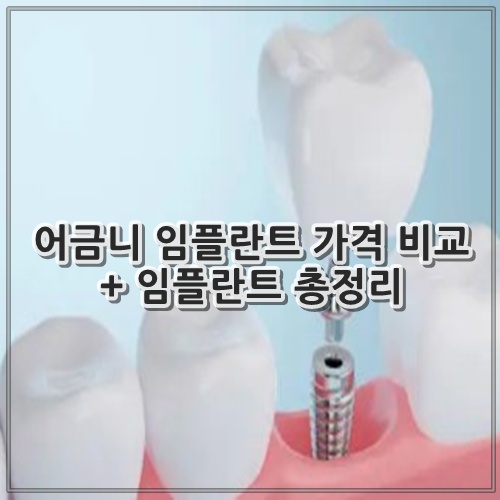 어금니 임플란트 가격 비교 + 임플란트 총정리